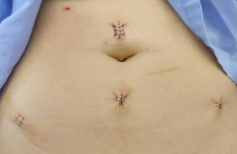 6052-wounds_laparoscopic_myomect