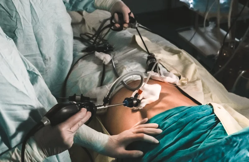 FeM-laparoscopic-nephrectomy-sca