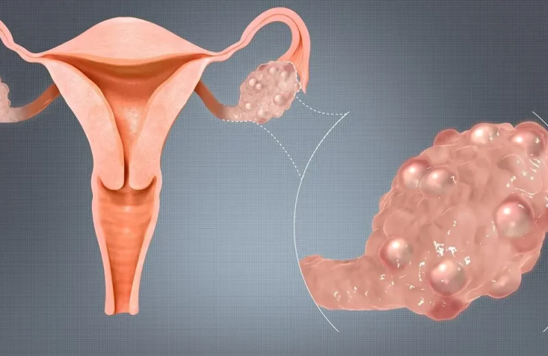 Polycystic_Ovaries-1280x640