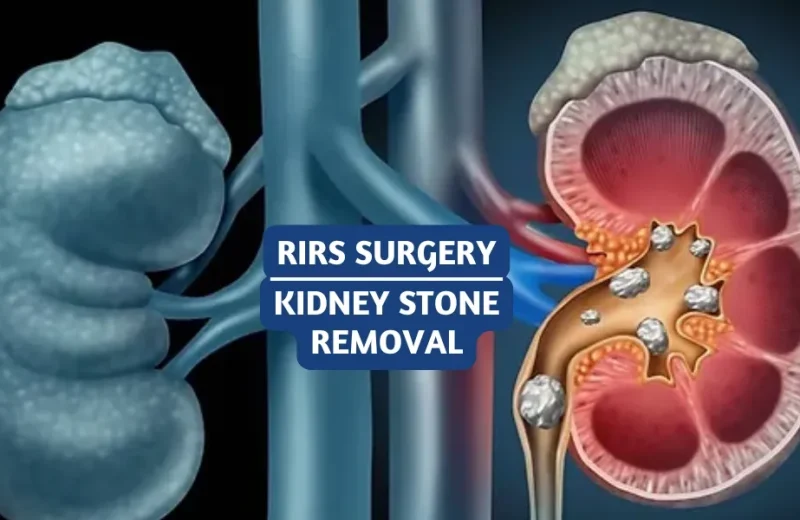 RIRS-Surgery