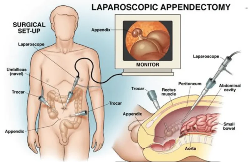 SAGES-PI-Appendix-Removal