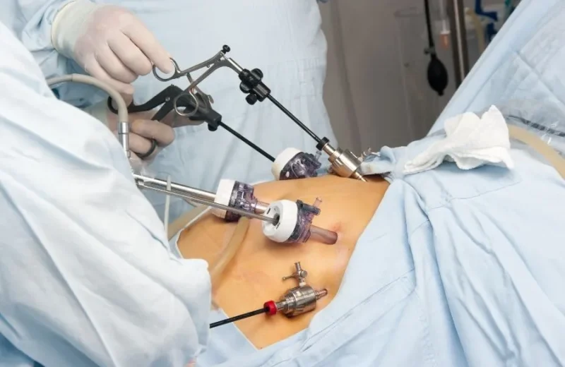 laparoscopy