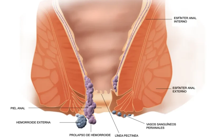piles-treatment-1024x757