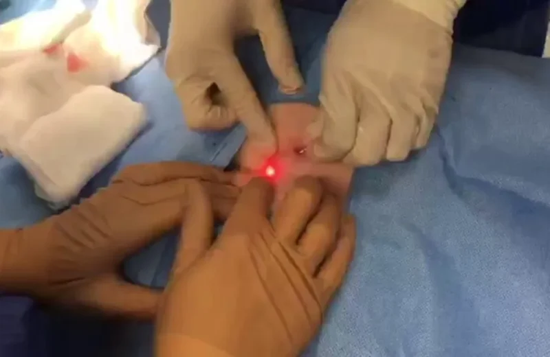 tratamiento-laser-pilonidal-1024