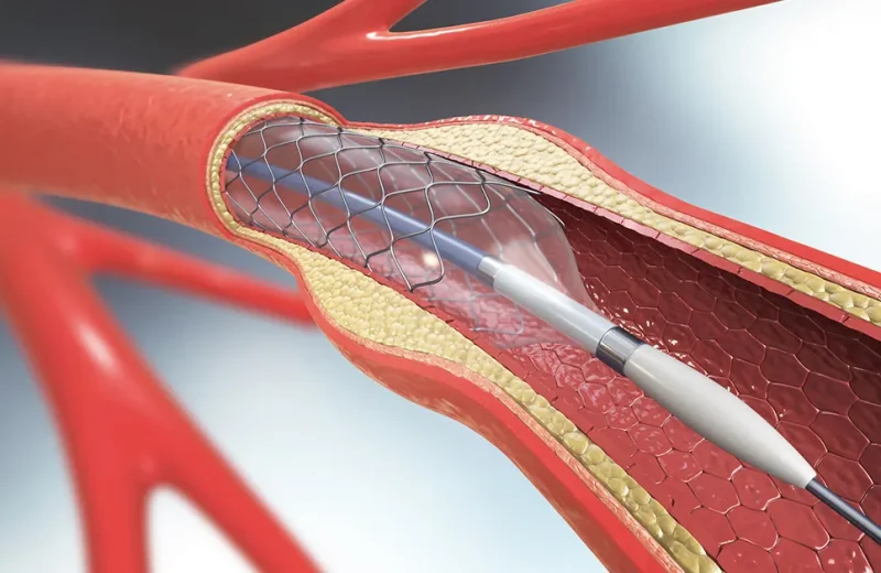 vascular-stents_1200x628